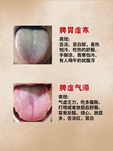 ​脾胃不好的6种证型，对照舌苔，你是哪一种？