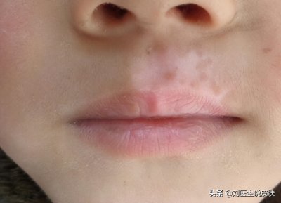 ​治疗白癜风的方法 白癜风到底能不能治好？常见的治疗方法有哪些？一篇文章说清