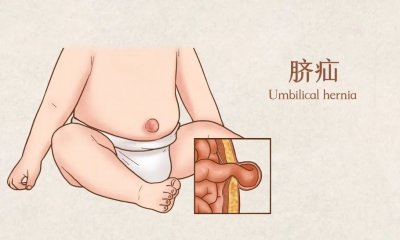 ​什么是脐疝？