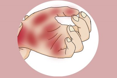 ​肝掌是什么样的？手掌上的“1红1白”要警惕，小心肝脏出问题