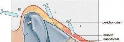 ​玻尿酸隆鼻失败案例