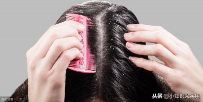 ​怎样去头屑 教你一招，轻松去头屑，头屑不再来